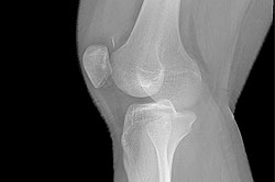 Как разработать коленный сустав после травмы